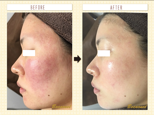 ハーバルピール施術・ホームケア | Becarnet ~ ビカルネ.~