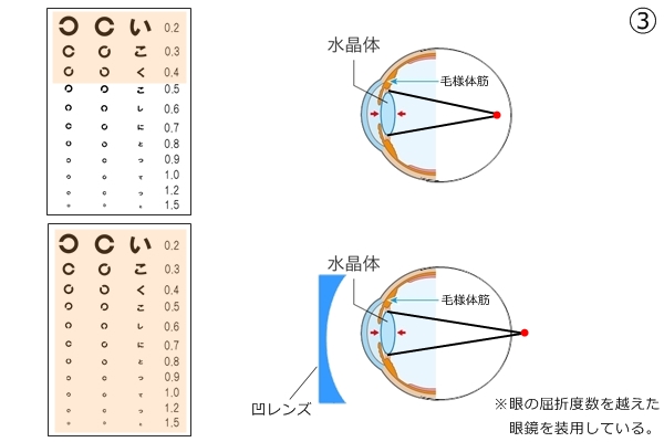 □「屈折異常と、その矯正 vol.1」眼は近くを見た時に、違う屈折異常に