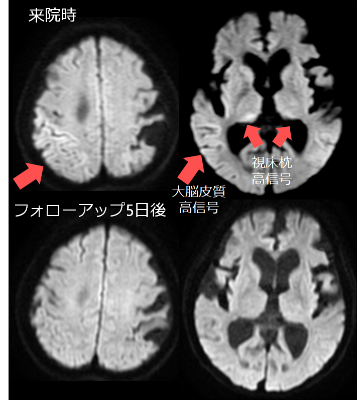 てんかん重積とMRI所見の対応│医學事始 いがくことはじめ