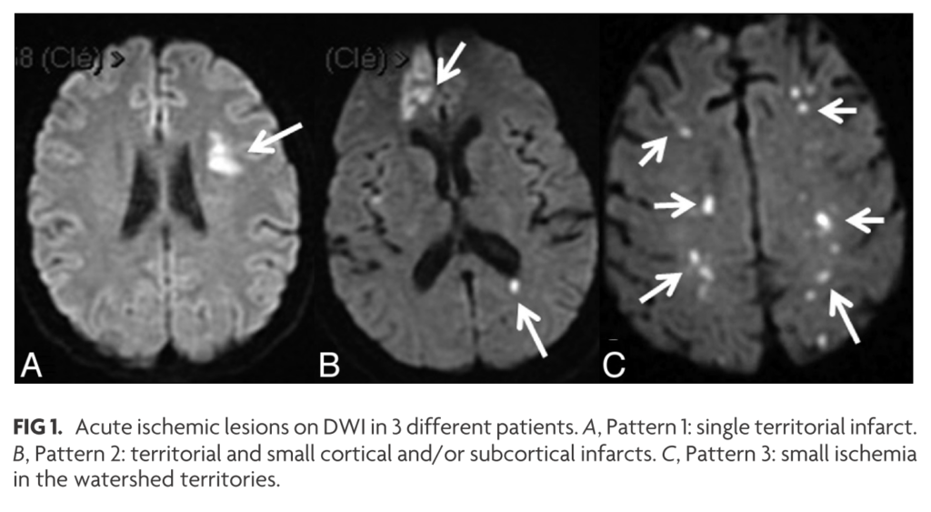 感染性心内膜炎と中枢神経合併症│医學事始 いがくことはじめ