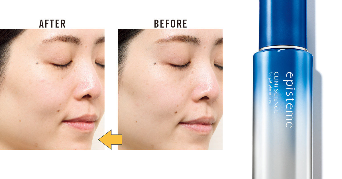 即効性に驚き！ エピステーム「ブライトプラズムレーザー」のお試し