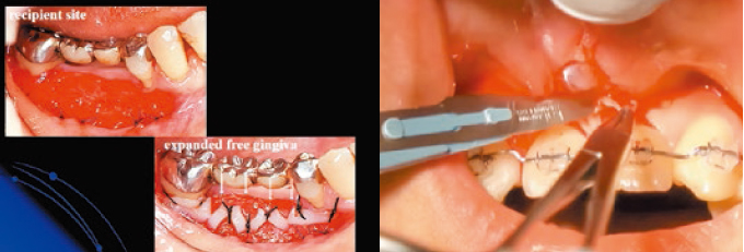 プラスティックサージェリーを究める～遊離歯肉移植・結合組織移植の