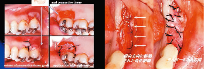 プラスティックサージェリーを究める～遊離歯肉移植・結合組織移植の