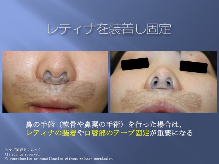小鼻（鼻翼）縮小術で大切なこと〜その適応と術後ケア（鼻孔レティナ