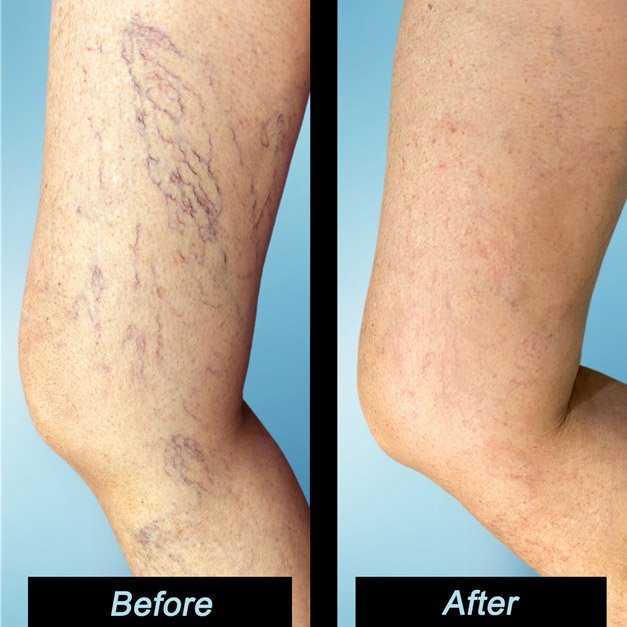 Spider Veins Treatment in Tampa | Comprehensive Care Solutions