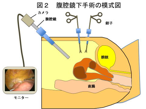腹腔鏡下手術 | 徳島県産婦人科医会