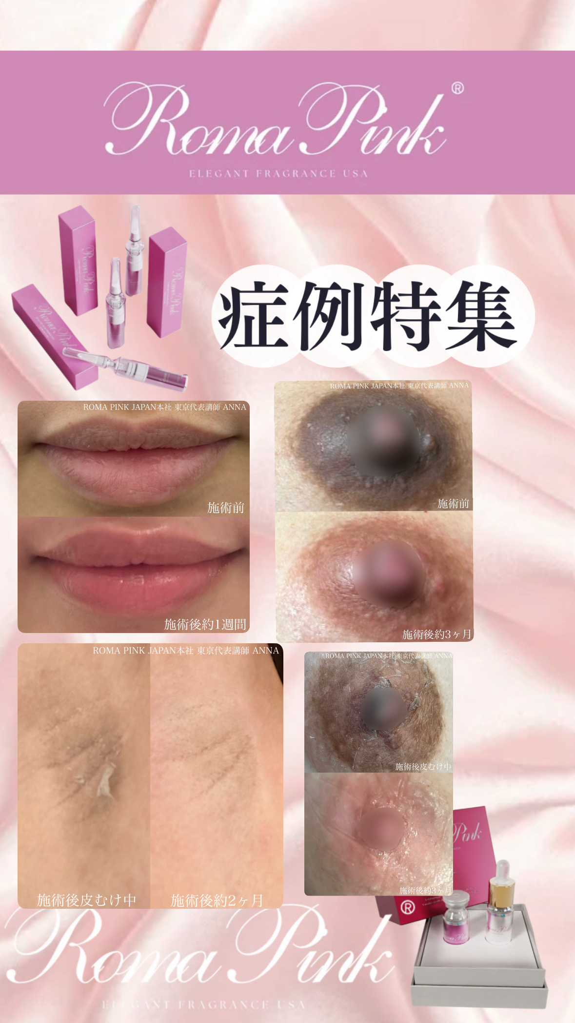 ローマピンク】ローマピンクでメラニン除去｜本社スタッフが担当