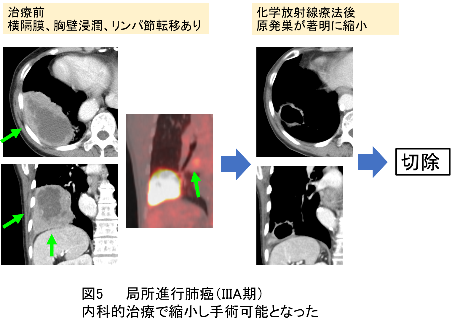 肺がん | 大阪赤十字病院がん診療センター