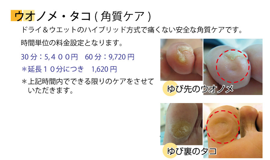 施術料金/巻き爪補正（巻き爪＆フットケアのペディグラス）／タコと