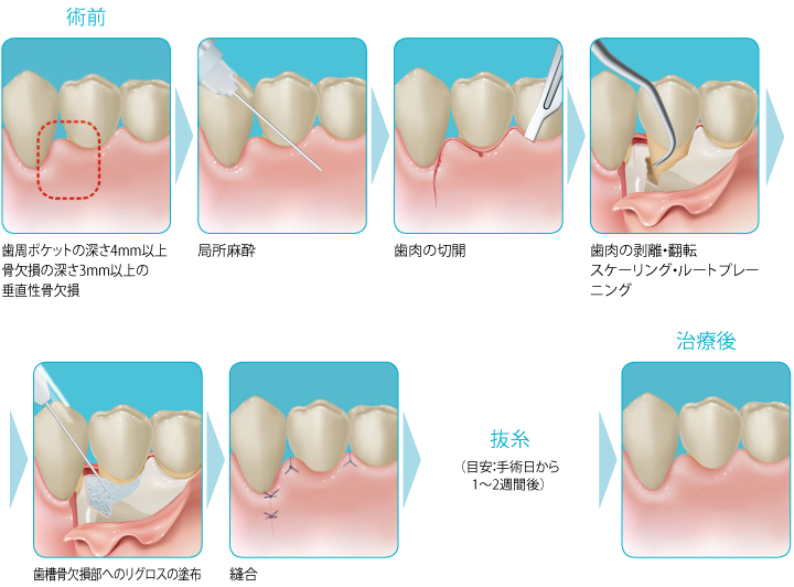 歯周組織再生療法 | 渡辺歯科医院
