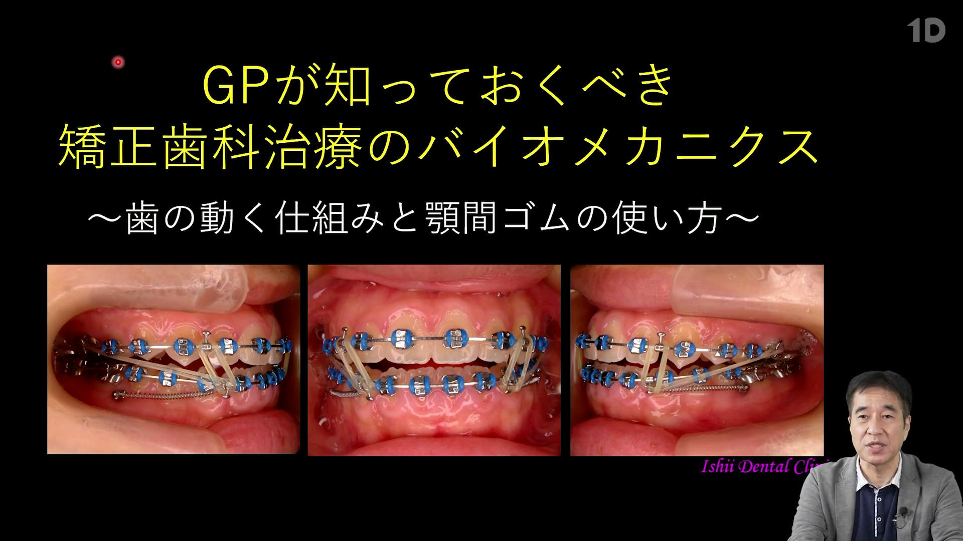 歯周矯正 GPがすべき五つの矯正治療 歯周矯正 GPが