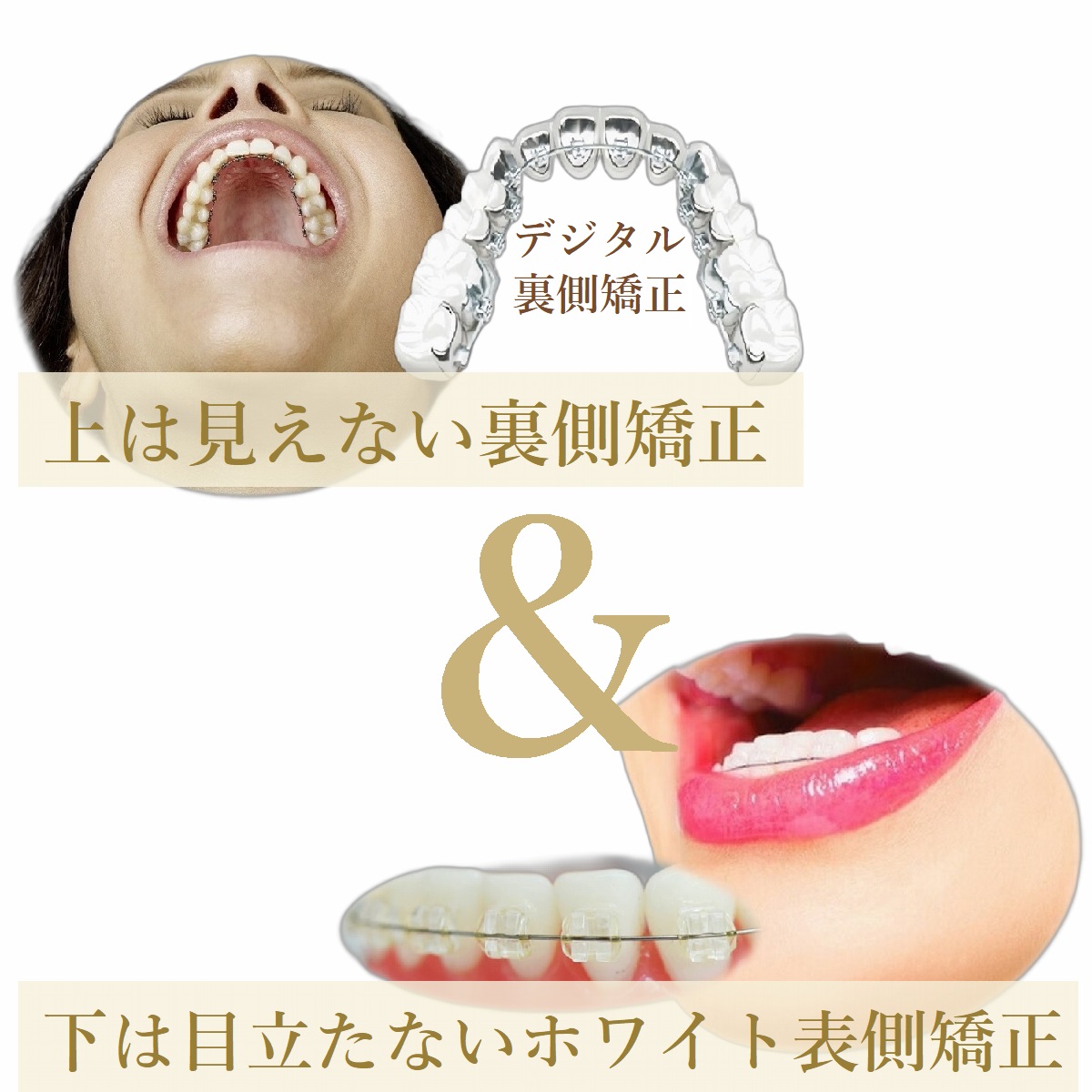 TBDCハーフリンガル矯正