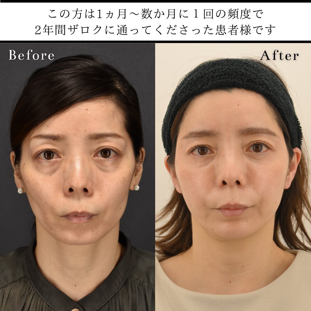 似合わせヒアルロン酸®（ヒアルロン酸注射） | 六本木・恵比寿のTHE