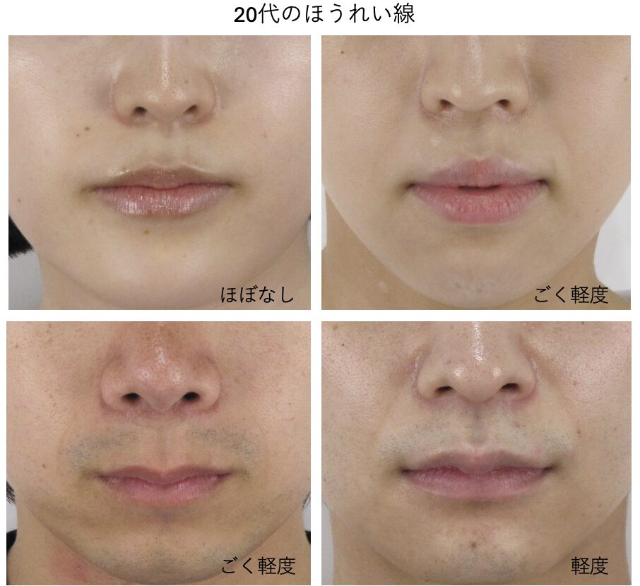 20代が悩むほうれい線の特徴と原因｜将来の予防も叶う治療法とは