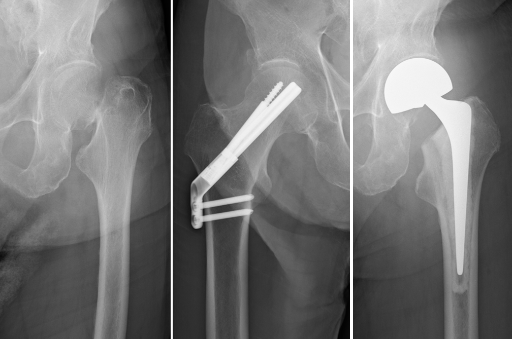 高齢者大腿骨近位部骨折 - 東京科学大学 整形外科
