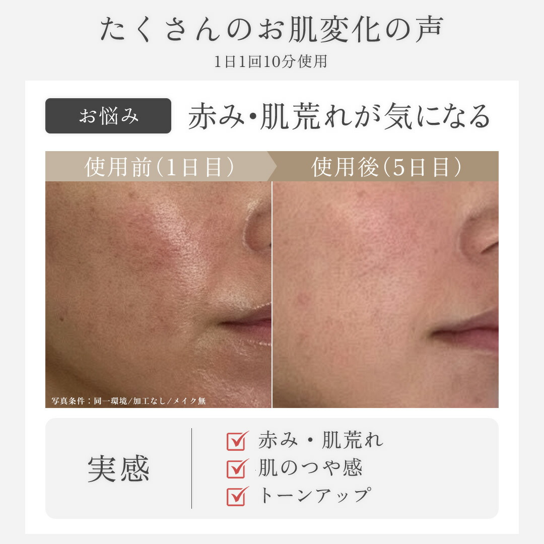 楽天市場】【5,000円OFF&ポイント10倍 3/1〜3/2】可変式RF×可変式EMS×3