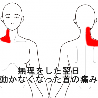 仕事中無理をした翌日動かなくなった首の痛み｜頚痛、寝違え（首の痛み