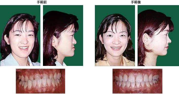 顎変形症の症例 | 鶴木クリニック医科・歯科鶴木クリニック医科・歯科