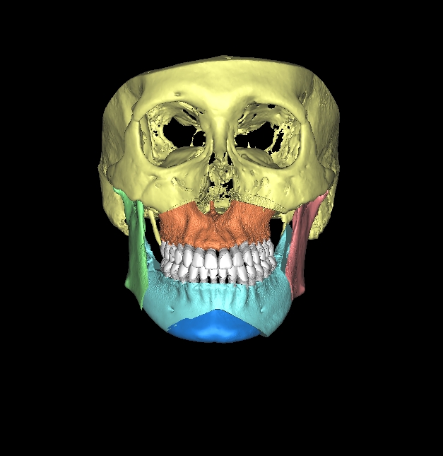 当院の顎変形症のシミュレーション vol.Ⅰ | ユニ矯正歯科クリニック