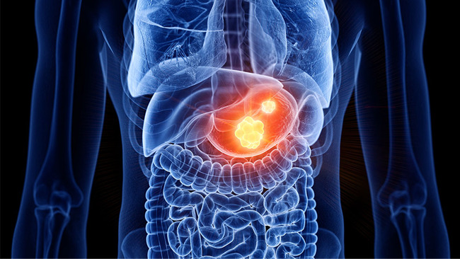 スキルス胃がんの全ゲノム解析で見えた治療標的 - 大学ジャーナル