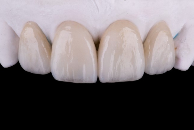 セラミック治療のご相談は心斎橋の歯医者『ウェルネスデンタルクリニック』