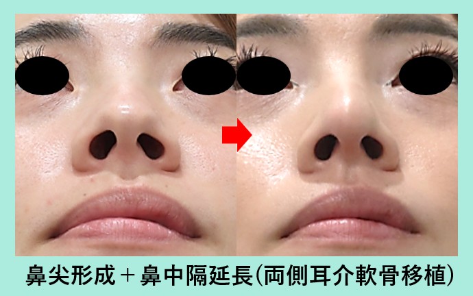 クローズド法で鼻中隔延長術＋鼻尖形成術。鼻表面に一切の傷なし！No