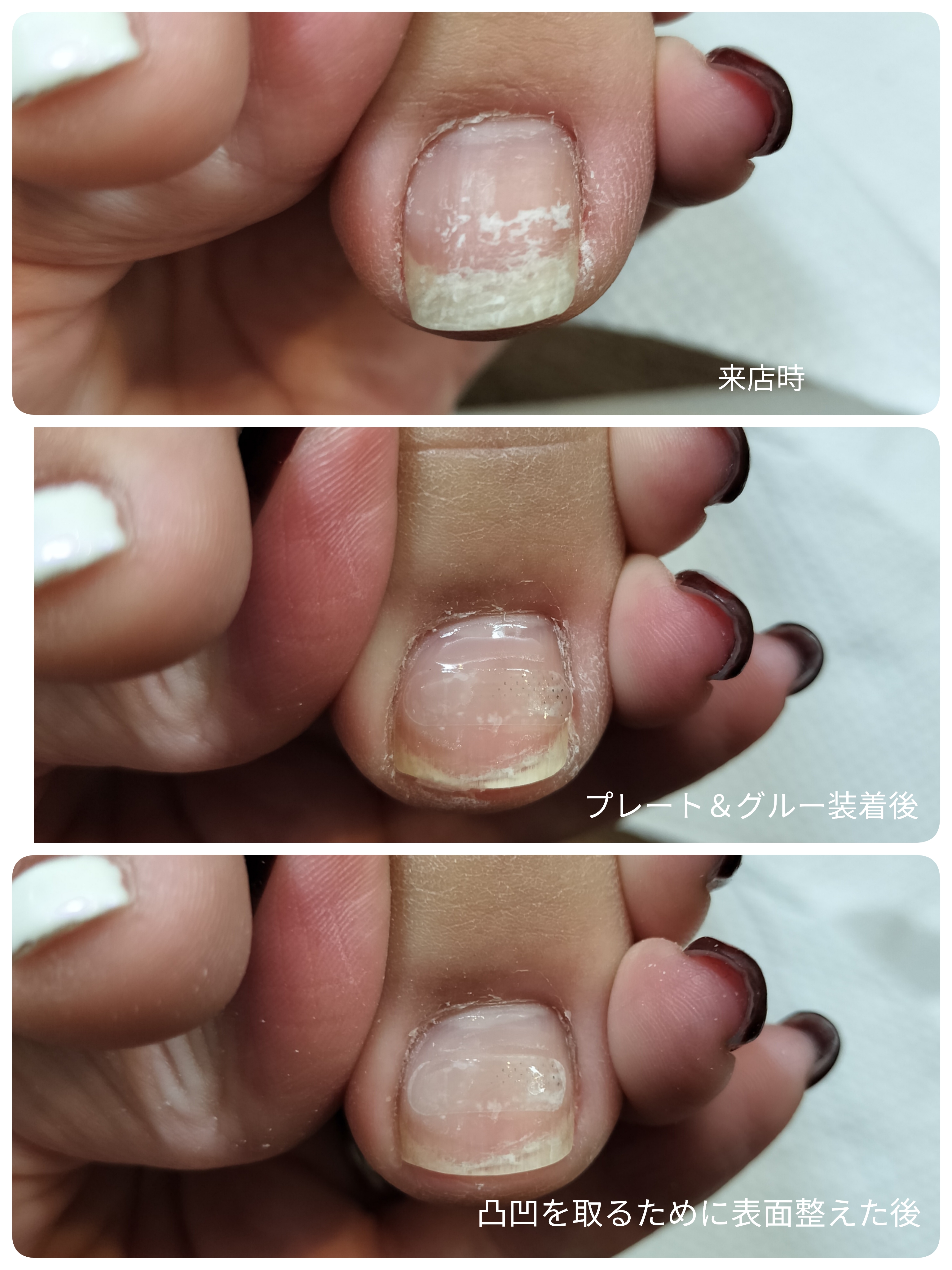 Resistance Plate System （レジスタンスプレート） | 元住吉 ネイル