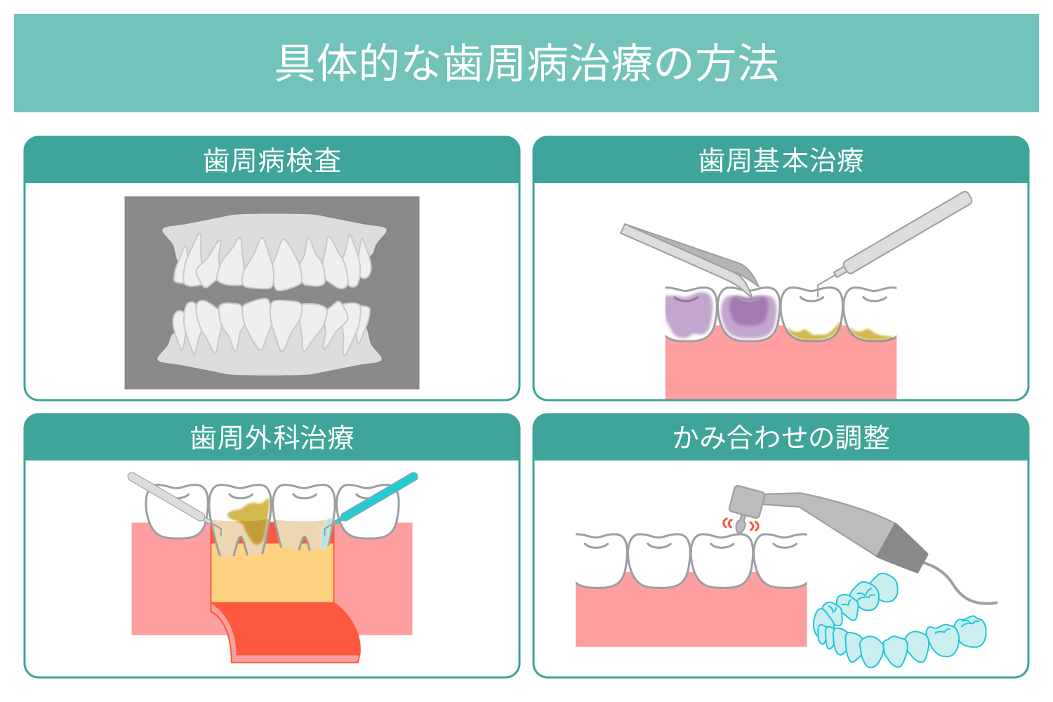 歯周病でもインプラント治療はできる？ 歯周病治療の方法や術後の注意