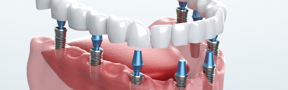 横浜】インプラント治療と矯正治療はどちらが先？最適順序の判断基準を