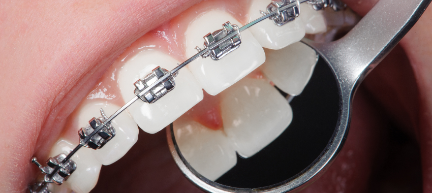 歯科矯正の歴史を知っていますか？矯正治療の進化とは？ | 東京都で