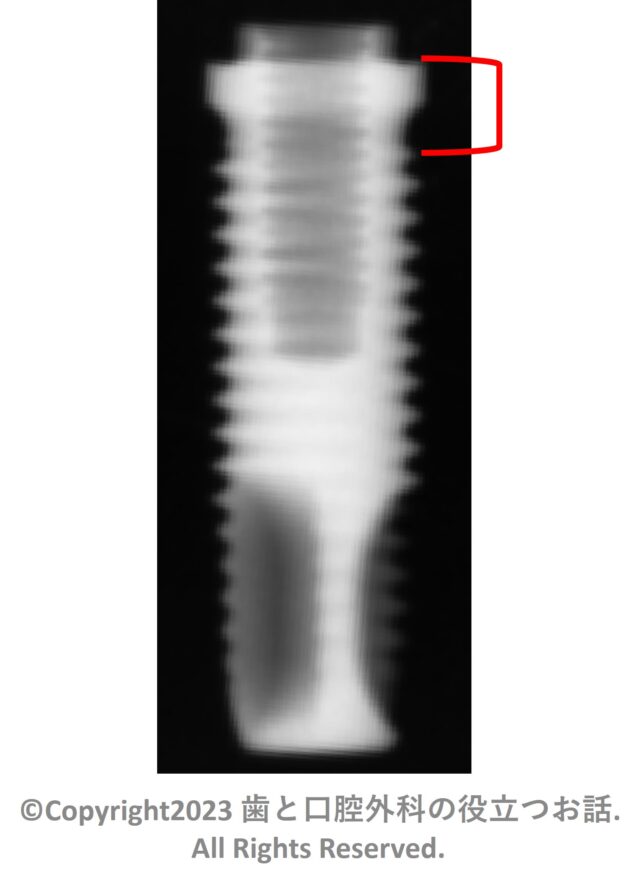 Nobel Branemark MkⅡ Self Tap Implantについて | 歯と口腔外科の