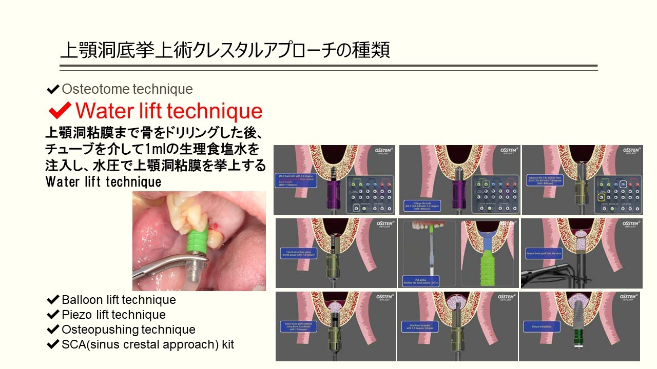 上顎洞底挙上術に関するQ&A上顎洞底挙上術に関するQ&A - 新谷悟の歯科