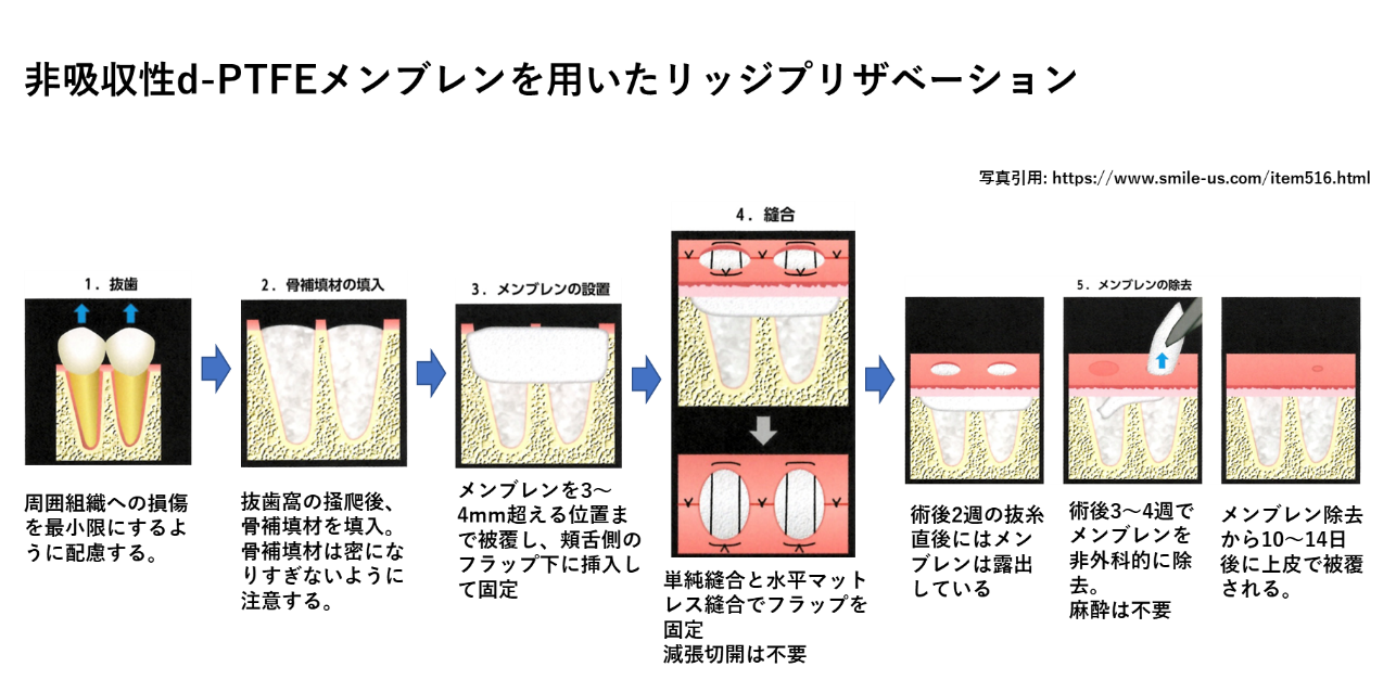 リッジ（ソケット）プリザベーションが大切である理由リッジ（ソケット