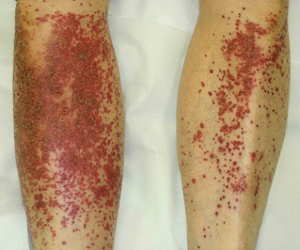 その他の皮膚障害 | がん治療の皮膚ケア情報サイト はだカレッジ | 第