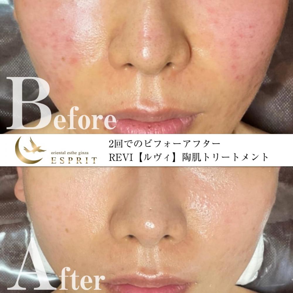 ハーブピーリング 剥離あり 20回分 ローション付き 【公式通販】