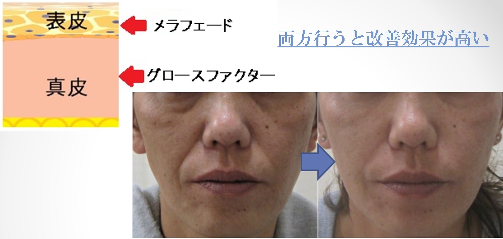 メラフェード」・・・通院せずに気軽に自宅でシミ・くすみ・小ジワ治療
