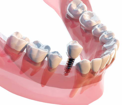 インプラント治療｜歯周病で歯を失った方へ骨造成に対応した