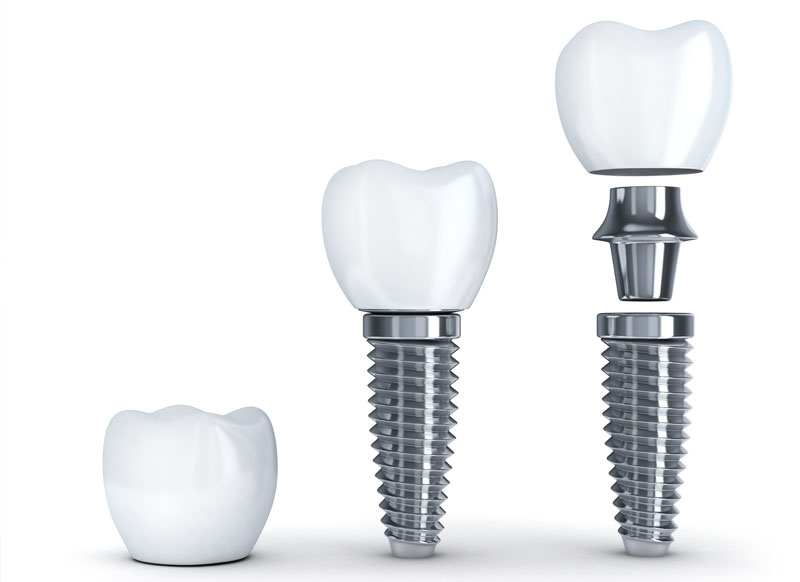 ストローマンガイドシステムによるインプラント治療 - 水戸・古木歯科医院