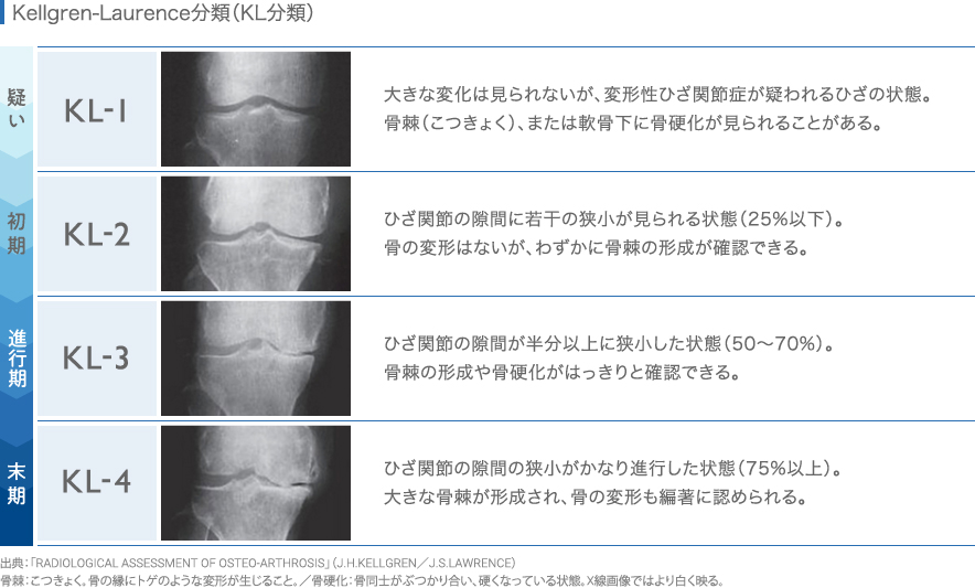 変形性膝関節症の手術【費用／タイミング／術後の入院期間】│ひざ関節