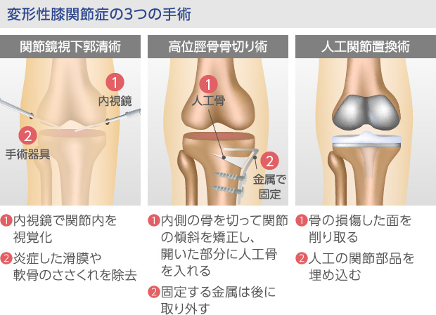 変形性膝関節症について | 再生医療のひざ関節症クリニック