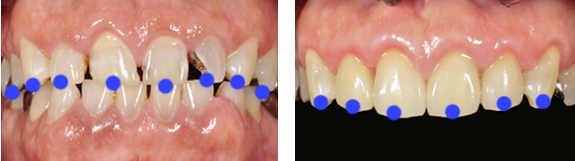 審美補綴による治療 | 稲沢市の歯医者【けやき通り歯科クリニック】