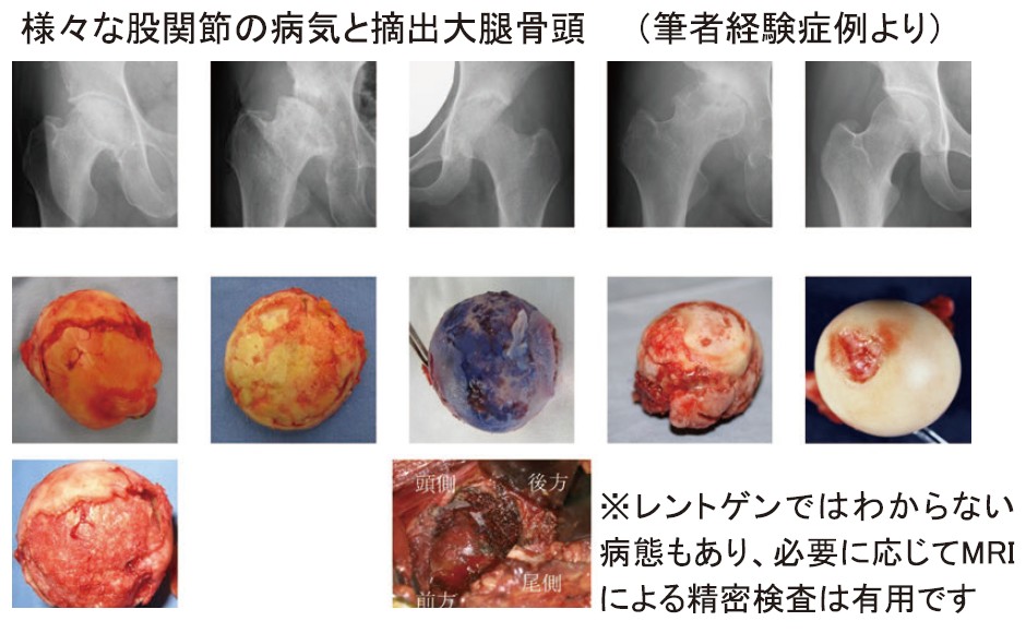 突然の股関節 大腿骨近位部骨折治療と2次骨折予防｜病気のはなし｜公立
