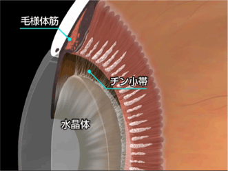多焦点眼内レンズ | 手術 | 清瀬えのき眼科｜白内障日帰り手術など眼科手術