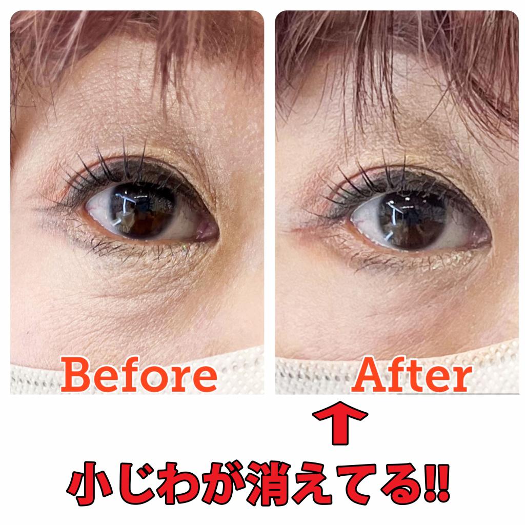 Σ(゜Д゜ノ)ノ 嘘っ!】小じわが消えた!!【アルビオンのアイクリーム