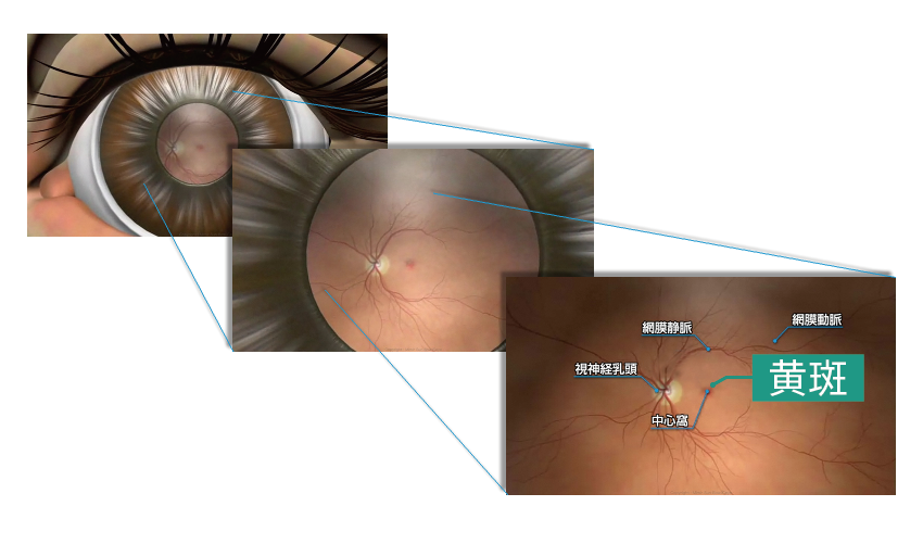 加齢黄斑変性について｜症状や見え方、治療方法について解説
