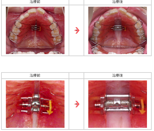 治療例つき】拡大床（かくだいしょう）とは？小児の床矯正で顎を拡大