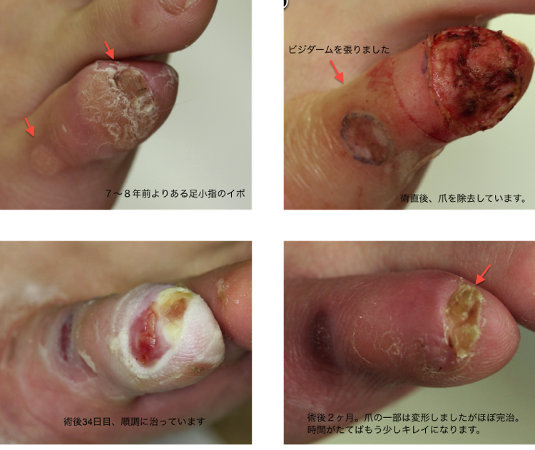 イボ治療の症例写真