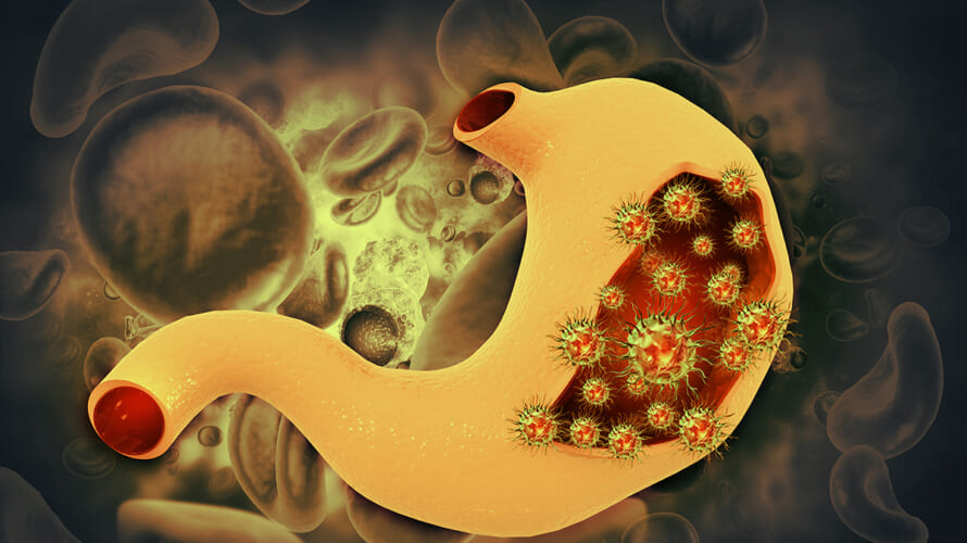 胃がんのはなし │ 広報誌あすなろ