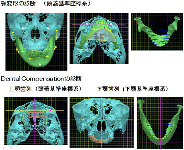 顎変形症などの骨格的な要因が強い症例の外科的矯正治療 | 矯正歯科