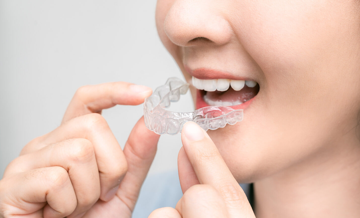 マウスピース矯正「インビザライン」│大阪・豊中市 ひがしさわ矯正歯科